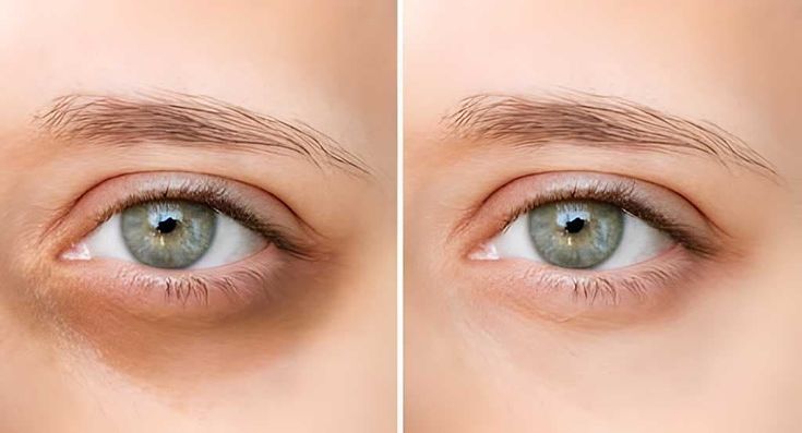 Dark Circles Treatment